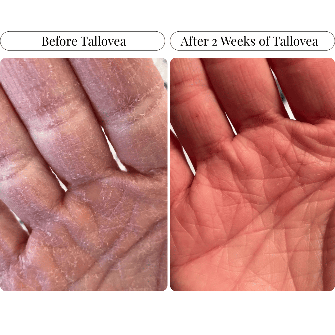 Tallovea™ Moisturizer