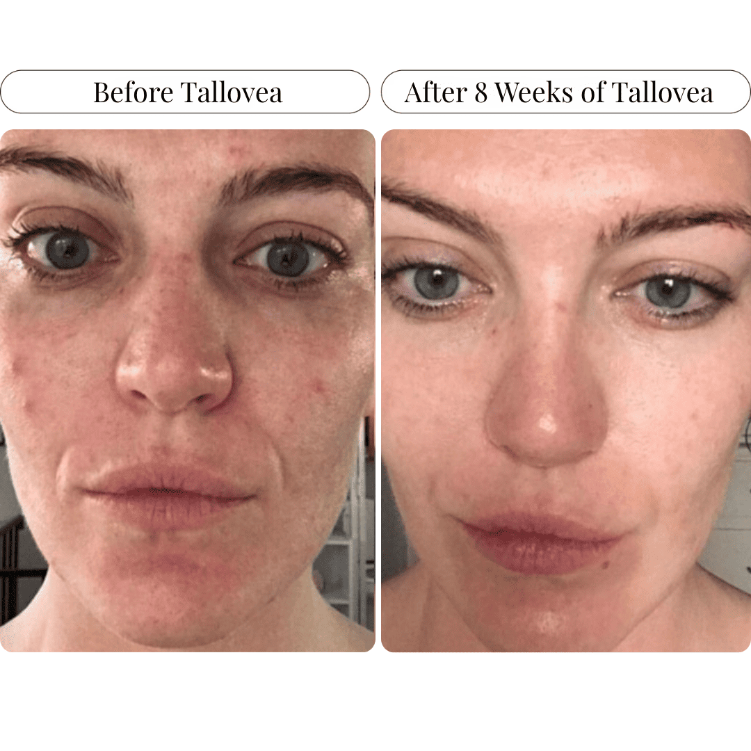 Tallovea™ Moisturizer