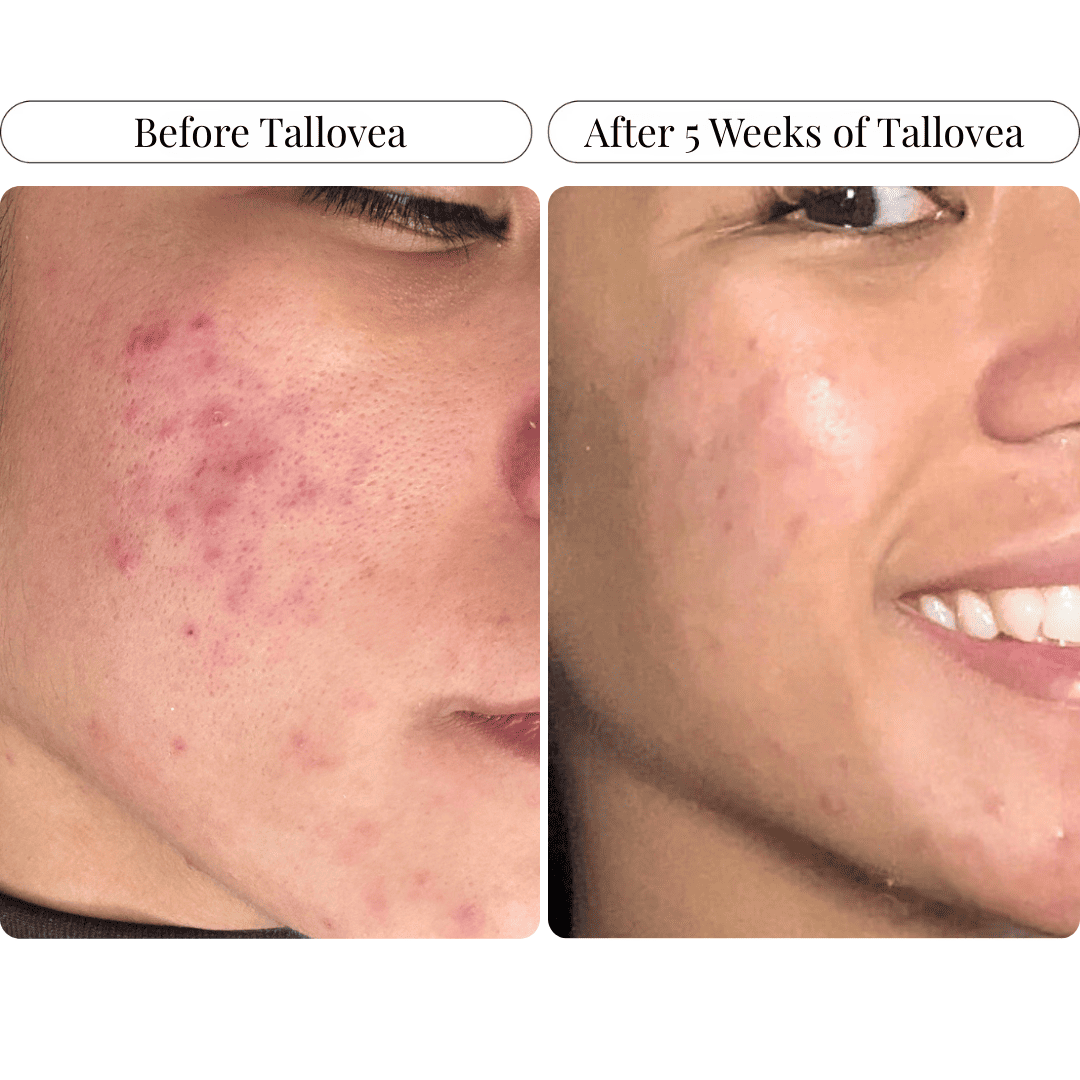 Tallovea™ Moisturizer